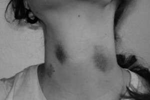black and white, bruises, neck