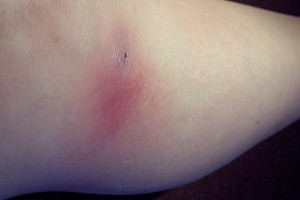 Brown Recluse Spider Bite Rash