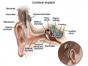 Cochlear Implants: Miracle Machines