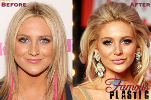 Famous Plastic - Celebrity Plastic Surgery Pictures and Celebrity C...