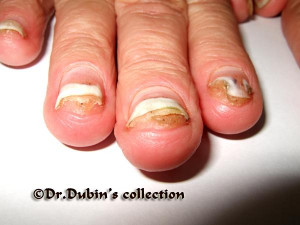 download this Artificial Nails Can Lead Nail Fungus Infections picture