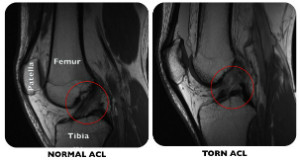 Normal vs Torn ACL MRI