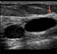 See the ultrasound images of the postsurgical breast below.