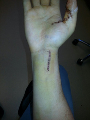 Finger tendon graft surgery, off the bike for a while-surgery.jpg