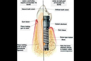 Dental Implant Quotes pictures
