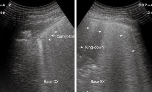 Ring Down Artifact Ultrasound
