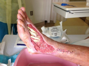 Bear Grylls tweeted this photo of his producer's snake bite injury ...