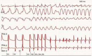 Monomorphic Supraventricular Tachycardia Figure 9: click to enlarge