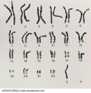 Karyotype of Turner s syndrome