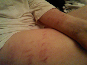 Self Harm Stomach With disscussing self harm