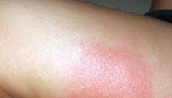 Mosquito Bites Swellingheated