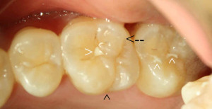 what does a cavity look like on a tooth