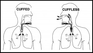 Cuffed vs Uncuffed Tracheostomy Tube