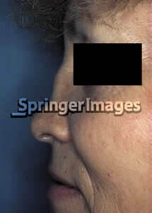 Wegener 39 s Granulomatosis Saddle Nose