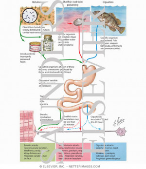 Food-Borne Neurotoxins - Netter Medical Artwork