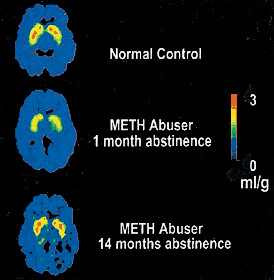 Does Meth Damage The Brain