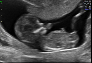 Early Ultrasound Gender Prediction