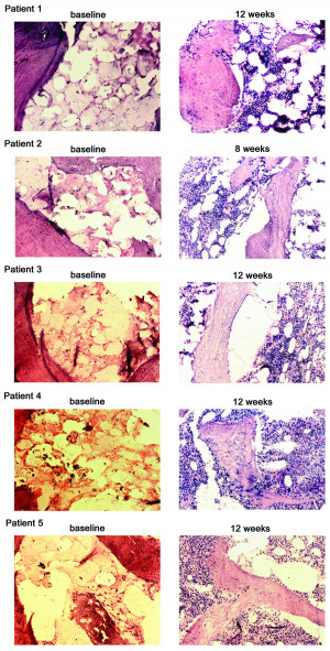 Aplastic Anemia Bone Marrow