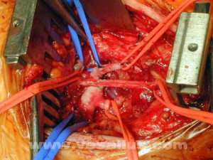 Carotid Artery Subclavian Bypass