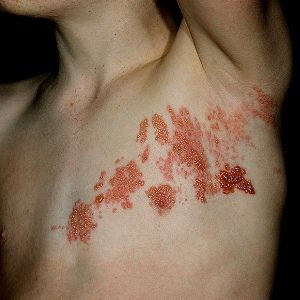 of these Natural Cure For Shingles Pain works, but I've had shingles ...