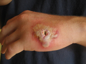 Staph Infection On Hand