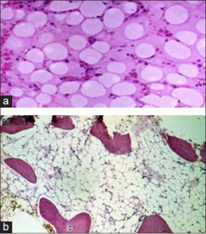 Aplastic Anemia