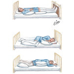 bed positioning for stroke patients
