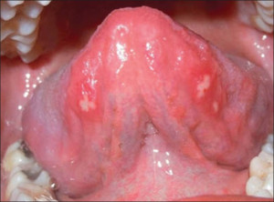 Aphthous Ulcer Under Tongue