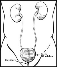 Non Muscle Invasive Bladder