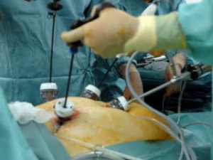 ... obesity surgery death rates low reads obese but worried that surgery