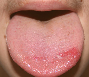 Acid Reflux Tongue