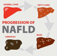 ... Liver Disease (NAFLD) affects up to 25% of people in the United States