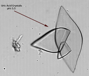 Uric Acid Crystals Urine