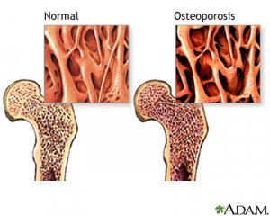 هشاشة العظام (osteoporosis )