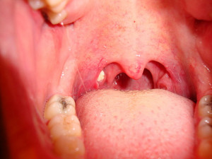You May Get My Free E-Report On “ Steps To Cure Tonsil Stones “