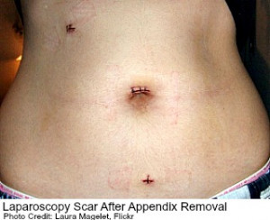Appendectomy Scar