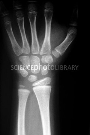 Healthy Hand Bones X Ray