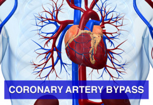 Coronary Artery Bypass Surgery