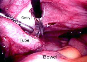 Testing and Treatment for Pelvic Factor Infertility and Pelvic ...