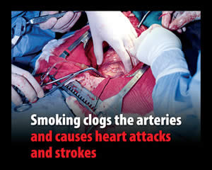 Smoking clogs the arteries