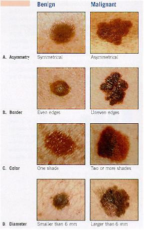 melanoma skin cancer Images and Graphics