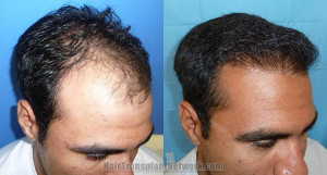 Hair Transplant Before and After Surgery
