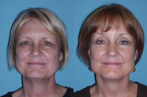 Cosmetic Surgery Fail Brow Lift Facial Body Implants