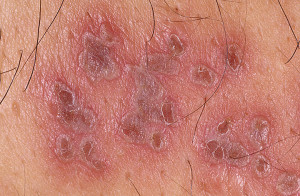 Herpes Zoster Occurs After Primary Infection...
