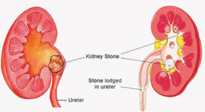 diagnosis of kidney stone the presence of kidney stones can