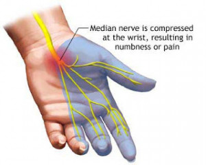 ... as wrist pain, you could be suffering from carpal tunnel syndrome