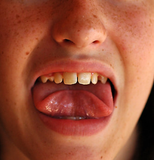 Black Spot Under Tongue