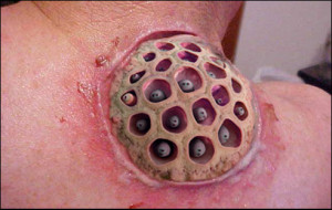 What is Trypophobia?