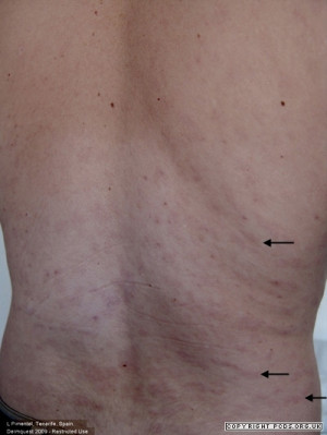 Secondary Syphilis Rash Rosea