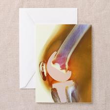 Knee replacement, X-ray Greeting Card for